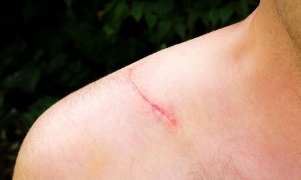 Peptides: Reduces Inflammation and Scar Tissue Formation