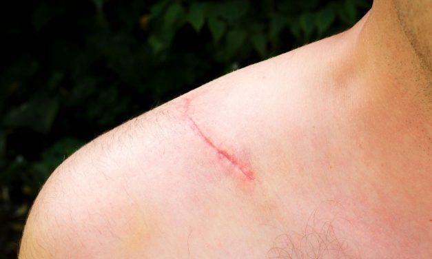 Peptides: Reduces Inflammation and Scar Tissue Formation