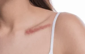 Peptides, Inflammation, Scar tissue, Wound healing, Fibrosis, Tissue regeneration, BPC-157, TB-500, Thymosin Beta-4, GHK-Cu, Copper peptides, Matrixyl, Palmitoyl pentapeptide, Argireline, Acetyl hexapeptide-8, Collagen production, Elastin synthesis, Skin repair, Anti-inflammatory, Anti-fibrotic, Muscle healing, Ligament repair, Tendon healing, Keloid prevention, Hypertrophic scar, Angiogenesis, Blood vessel growth, Tissue remodeling, Cellular regeneration, Skin regeneration, Post-surgical recovery, Cosmetic peptides, Injury recovery, Immune modulation, Healing peptides, Collagen balance, Pain reduction, Anti-aging, Skin care, Dermatology, Connective tissue, Soft tissue repair, Peptide therapy, Chronic inflammation, Skin health, Protein signaling, Topical peptides, Regenerative medicine, Bioactive compounds, Scar reduction