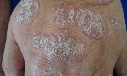 How Protein Peptides Help with Plaque Psoriasis