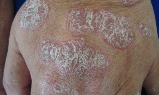 How Protein Peptides Help with Plaque Psoriasis