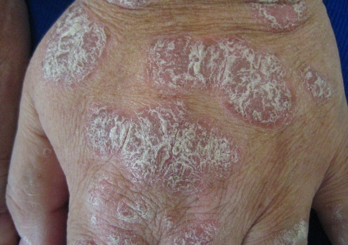 How Protein Peptides Help with Plaque Psoriasis